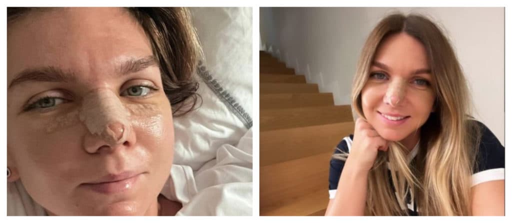 Și-a scos nasu' la purtare! Cum arată Simona Halep la o săptămână după operație /FOTO