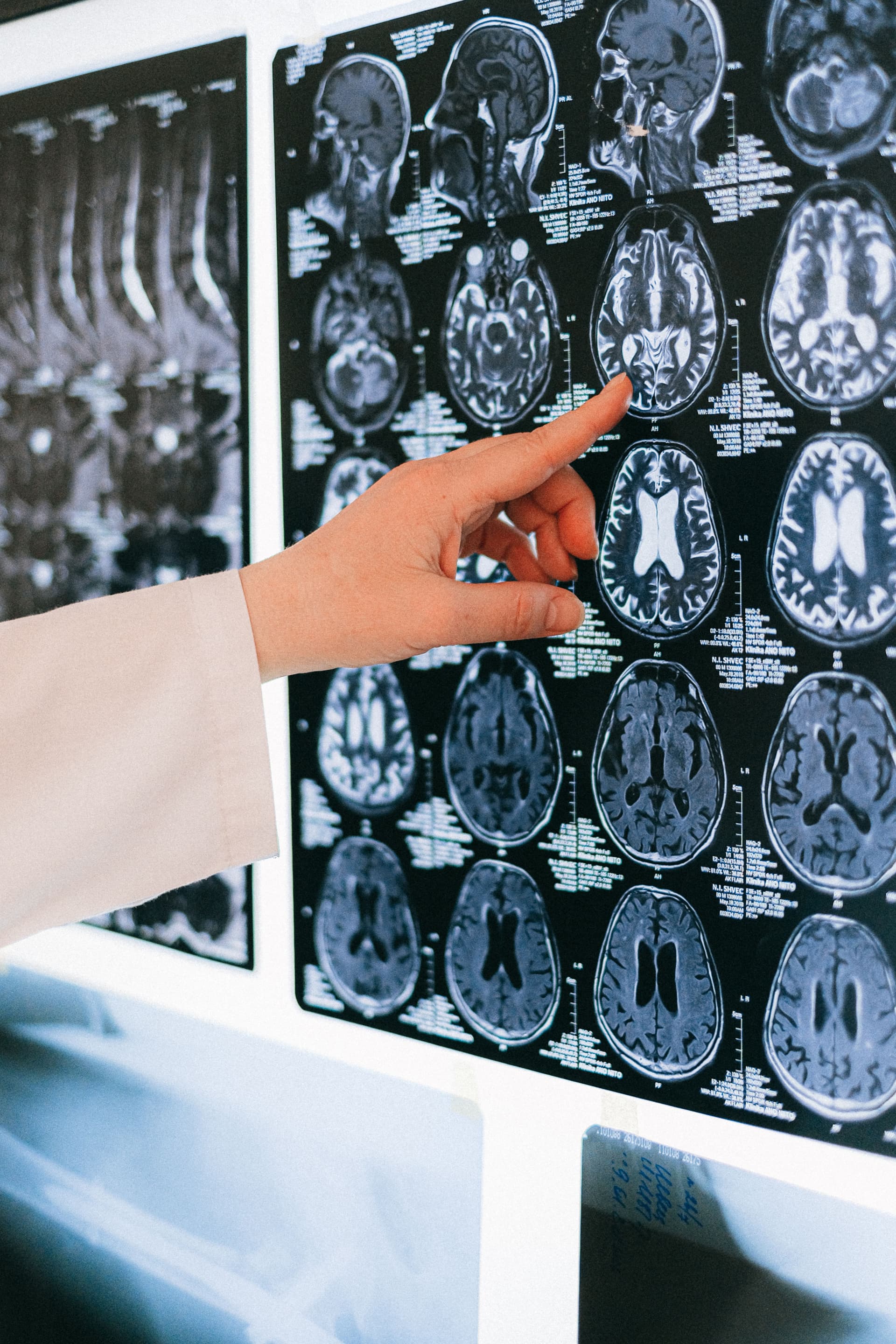 Comisia Europeană pune cercetarea cancerului cerebral în centrul luptei împotriva cancerului