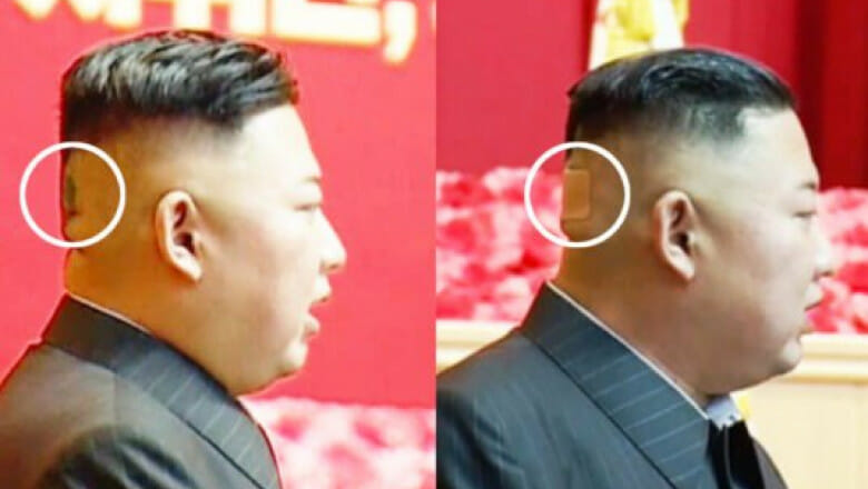 Bandajul de pe ceafa lui Kim Jong Un, ultimul mister de pe lista posibilelor probleme de sănătate ale liderului nord-coreean