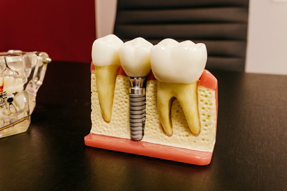 Ce recomanda specialistii in materie de implanturi dentare?