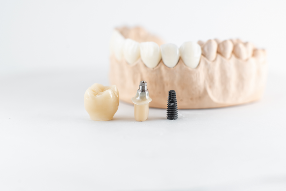De ce un implant dentar ar putea fi soluția la problemele tale dentare?