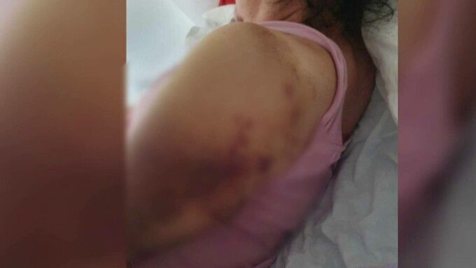 Revoltător! O femeie din Mureș dusă la spital cu gripă are acum fracturi la umeri și nu-și poate mișca brațele
